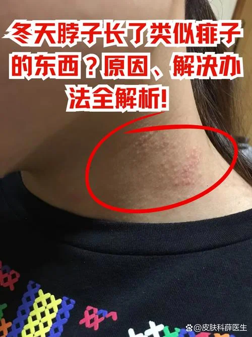 脖子起皮发黑怎么办_1