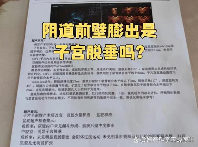 阴壁膨出自检_2