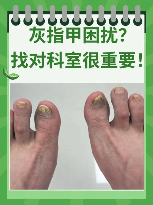 灰指甲是体内缺什么_1