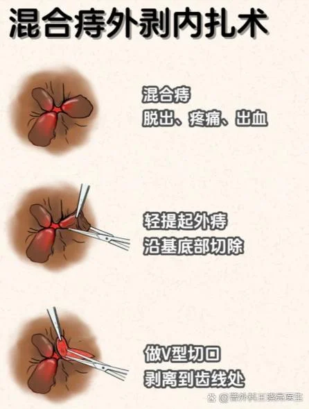 什么是环状内外混合痔_2
