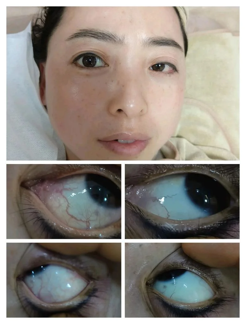 眼周抗衰的10个项目_2