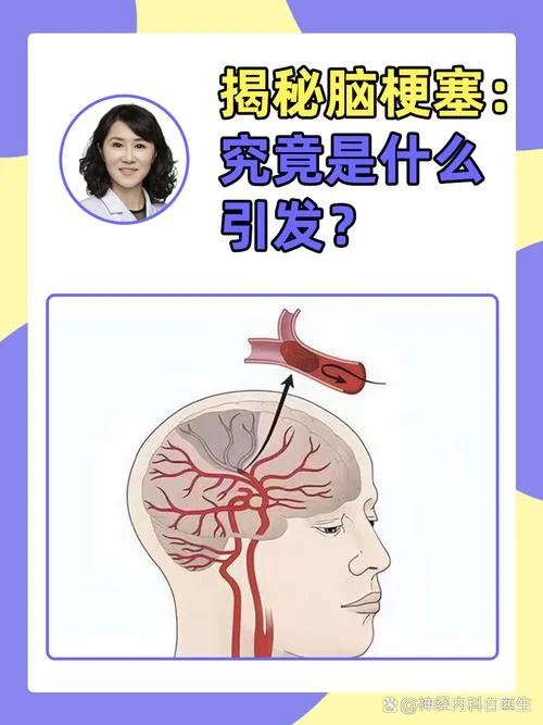 脑梗是怎么形成的原因是什么_2
