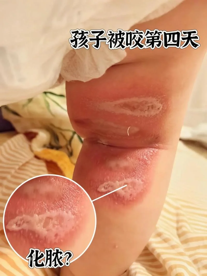 乳头被宝宝咬破化脓了怎么办-乳头化脓如何正确处理