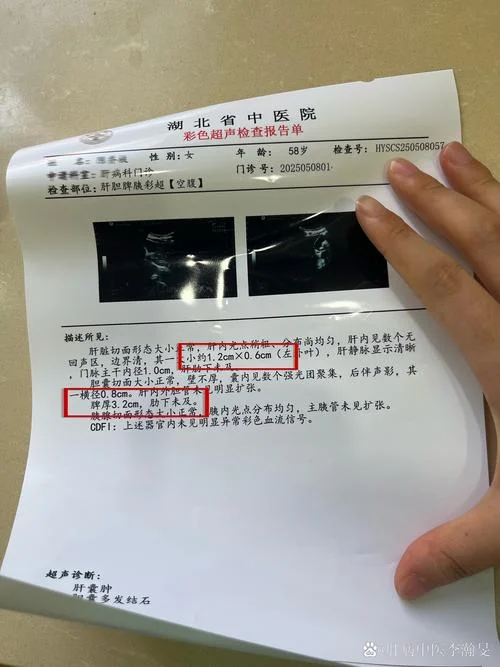 如何查肝脏纤维化_1