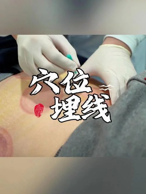 埋线减肥在哪里学_2