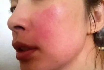 梦见脸过敏了起红疙瘩-梦见脸部过敏长红疙瘩