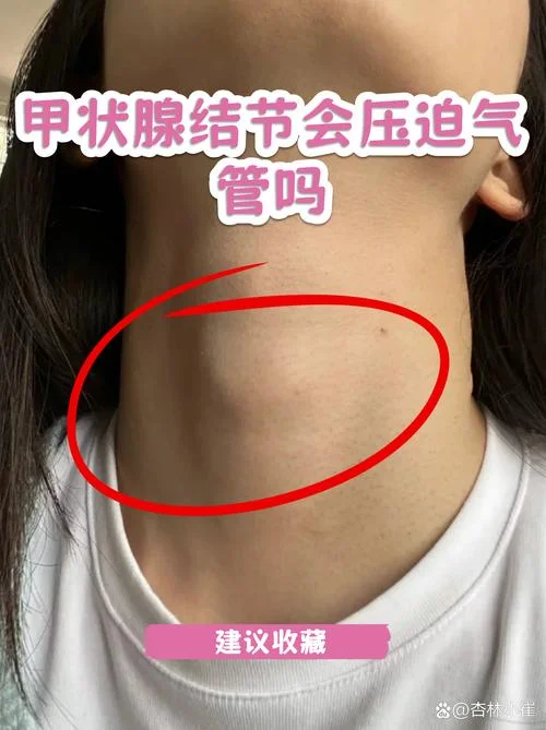 如何查甲状腺结节体积_1
