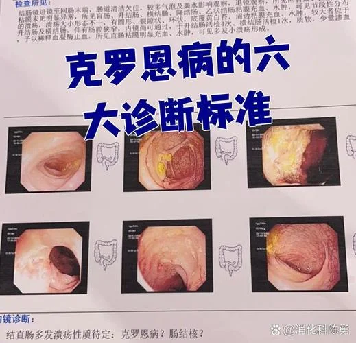 什么是克罗恩_2