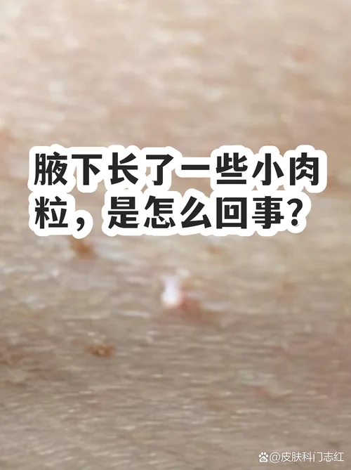 腋窝后面长肉叫什么_1