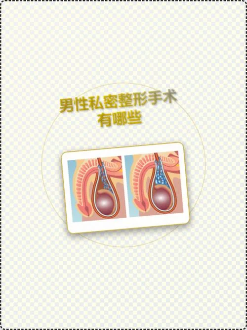 男性增粗手术叫什么_2