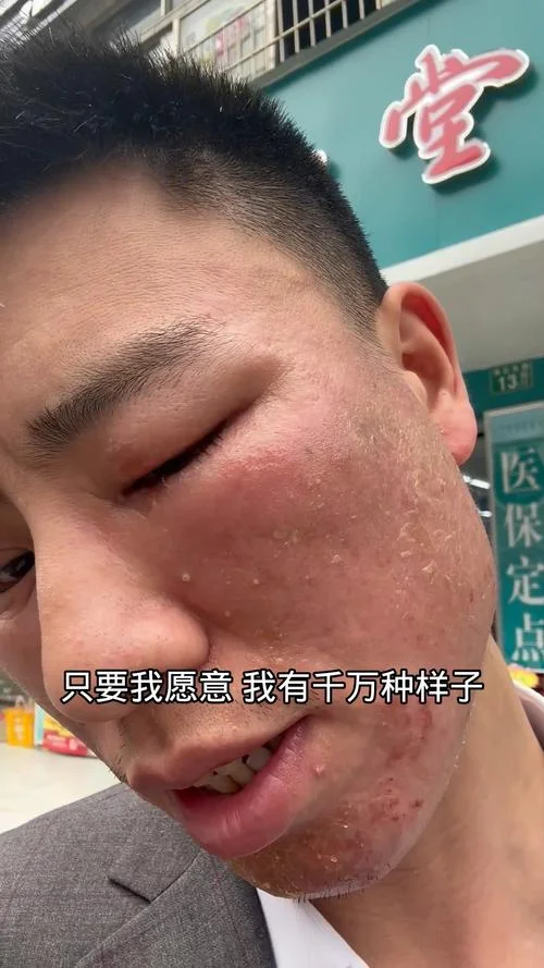 什么的症状是激素脸_1