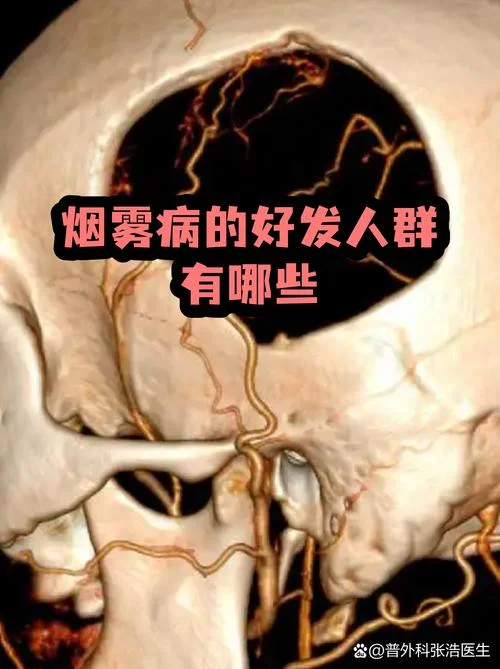 什么是烟雾病早期症状_1