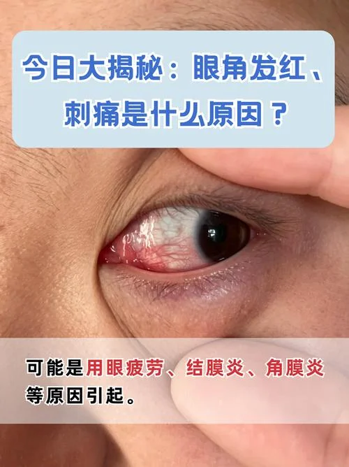 为什么有人的眼睛是红的_1