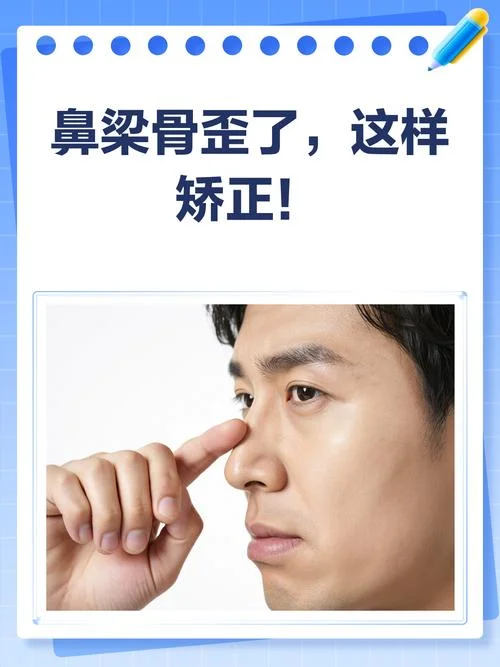 鼻梁摔歪了怎么办-鼻梁歪了如何恢复