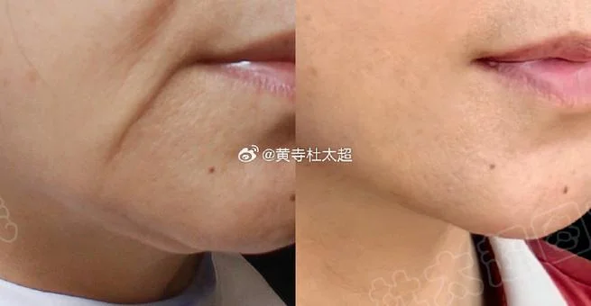 木偶纹 面相-木偶纹面相分析
