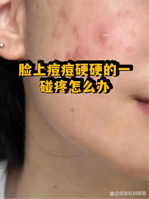 一碰就疼的痘痘叫什么-一碰就疼的痘痘