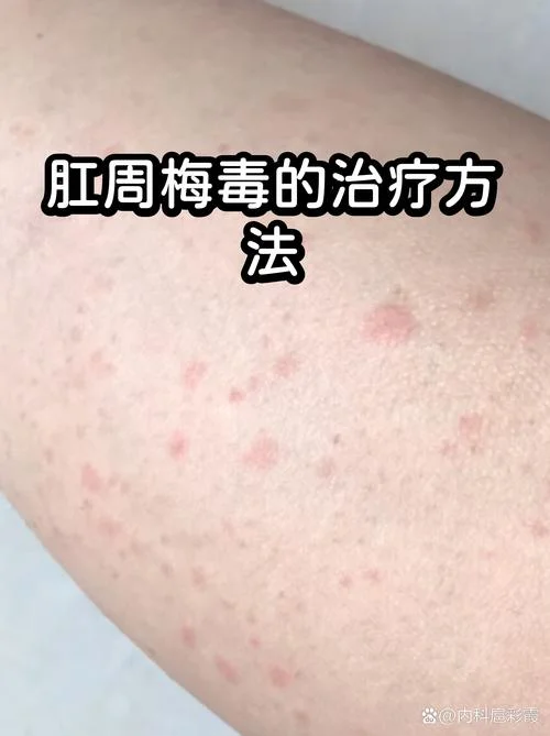 治疗梅毒需要多少钱-梅毒治疗花费