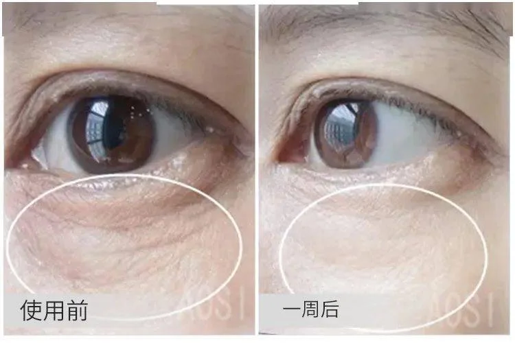 眼袋下面的皱纹叫什么_2
