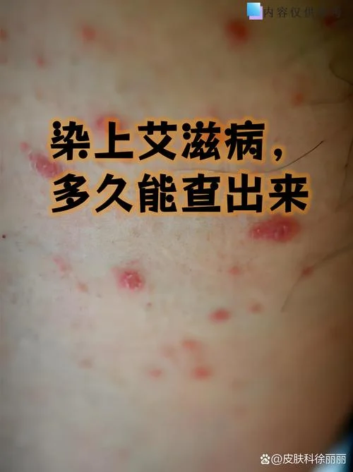 什么是艾滋窗口期_1