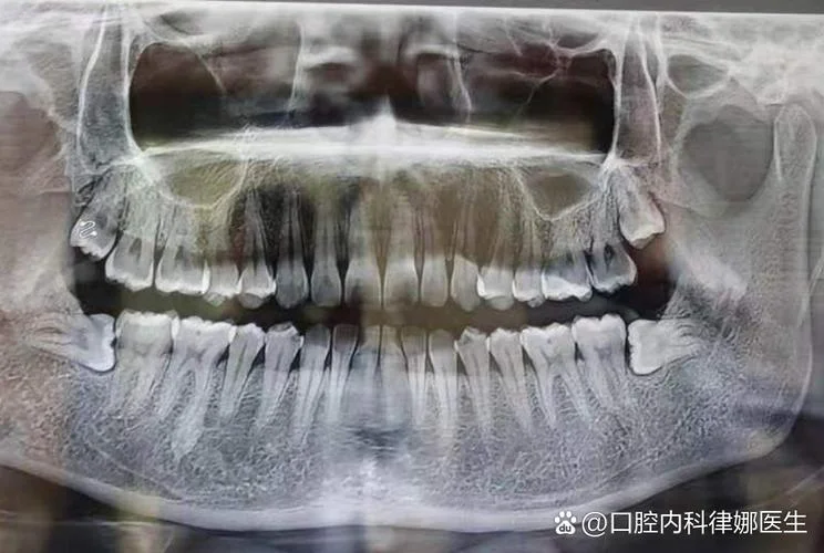 横着的智齿叫什么_1