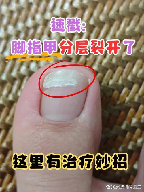 脚指甲掉了一半怎么办_1