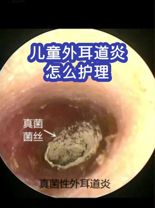 小孩油耳朵怎么办_1