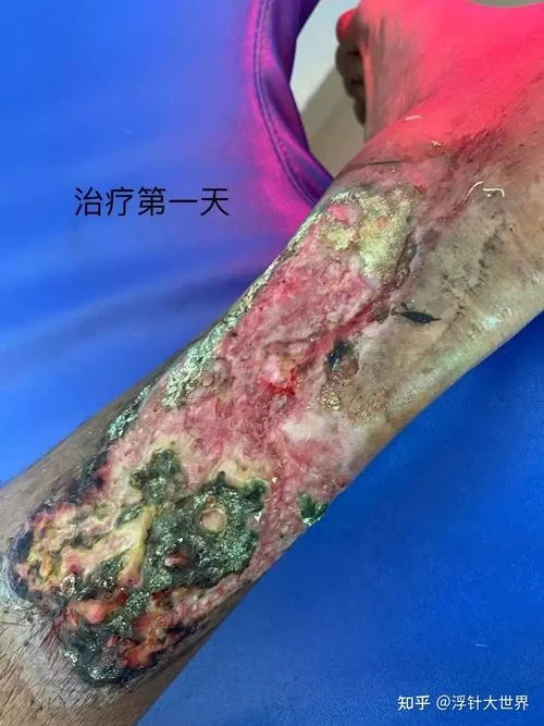 梦到皮肤溃烂_1